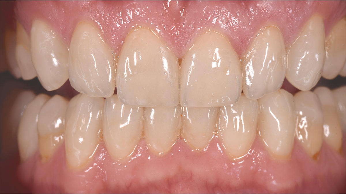 Celtra Press | Clinical Case | Final Situation