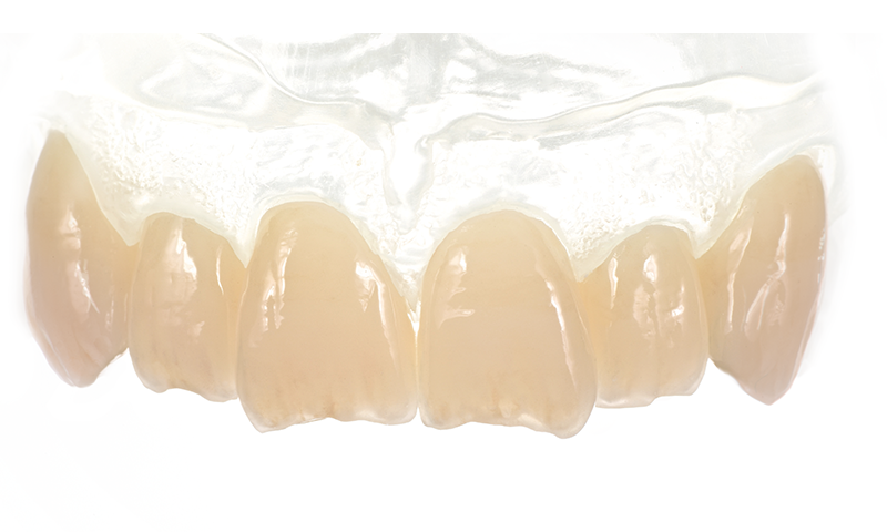 image of a full restoration with Celtra Press showing translucency and opalescence of the zirconia reinforced lithium disilicate material