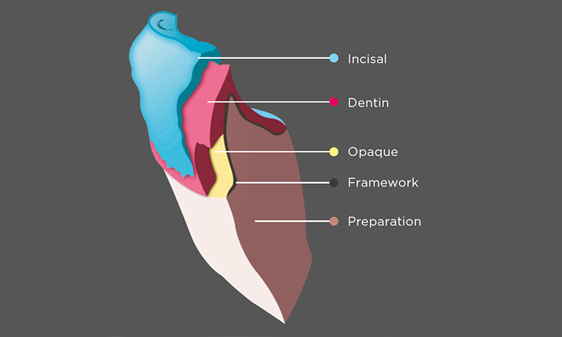 custom build-up technique in the anterior region with veneering porcelain;  Cercon ceram Kiss, Duceram Kiss, Duceragold Kiss
